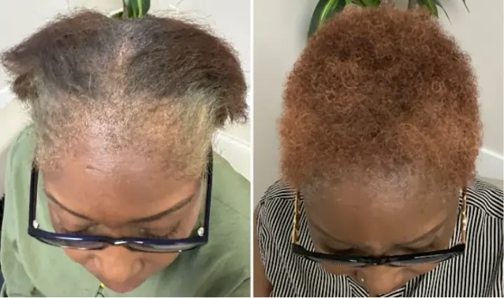 Female patient, Central Scalp Thinning — before and after stem cell hair restoration