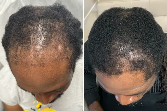 Female patient, Diffuse Central Thinning — before and after stem cell hair restoration