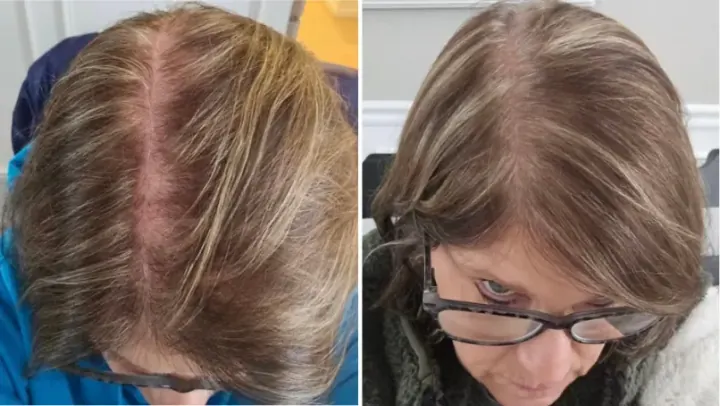 Female patient, Diffuse Thinning & Widened Part — before and after stem cell hair restoration