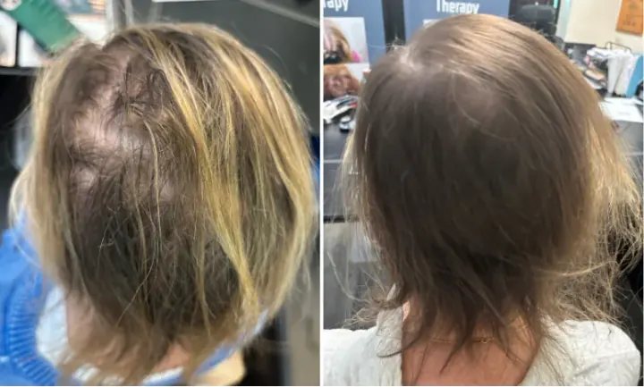 Female patient, Significant Diffuse Thinning — before and after stem cell hair restoration