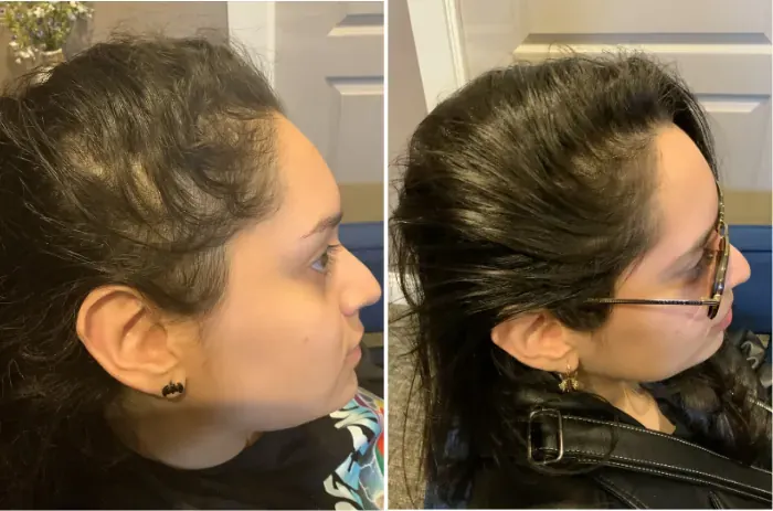 Female patient, Temple & Frontal Hairline Thinning — before and after stem cell hair restoration