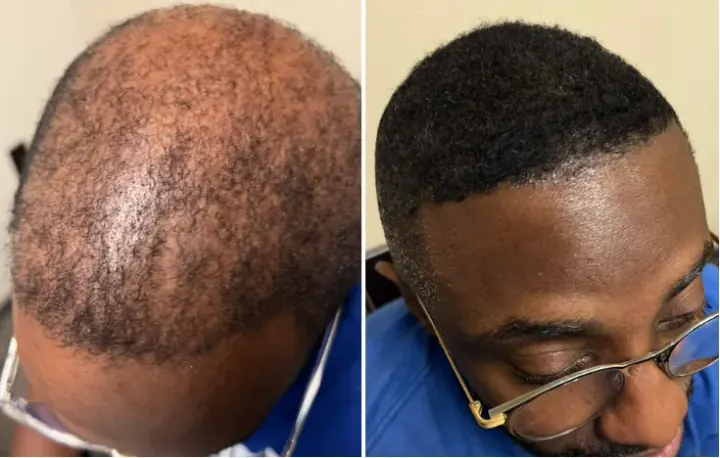Male patient, Advanced Diffuse Thinning — before and after stem cell hair restoration