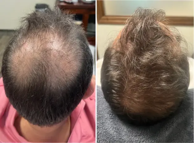 Male patient, Crown & Vertex Baldness — before and after stem cell hair restoration