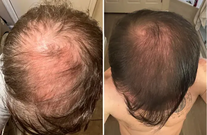 Male patient, Crown & Vertex Thinning — before and after stem cell hair restoration
