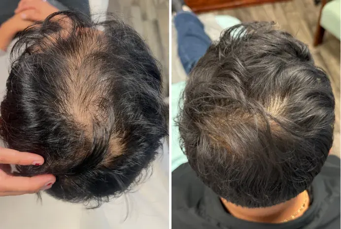 Male patient, Crown Thinning with Bald Patch — before and after stem cell hair restoration