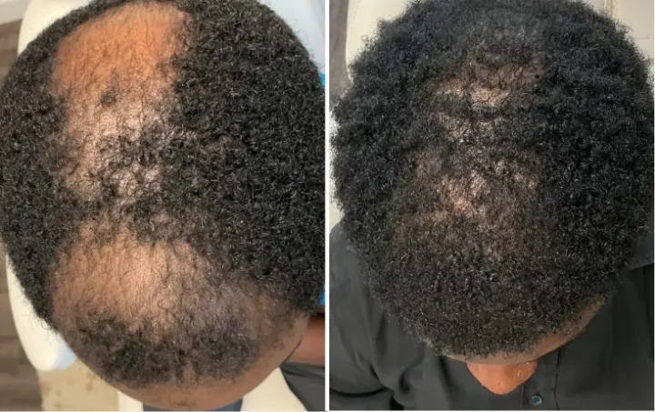 Male patient, Diffuse Crown Thinning (Afro-Textured) — before and after stem cell hair restoration