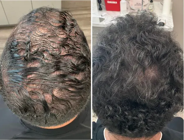 Male patient, Diffuse Crown Thinning — before and after stem cell hair restoration